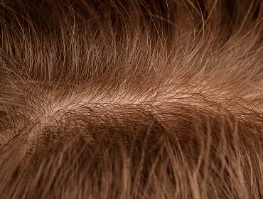 Как лечить очаговую алопецию?